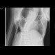 fibrodysplasia ossificans progressiva: X-ray - Plain radiograph